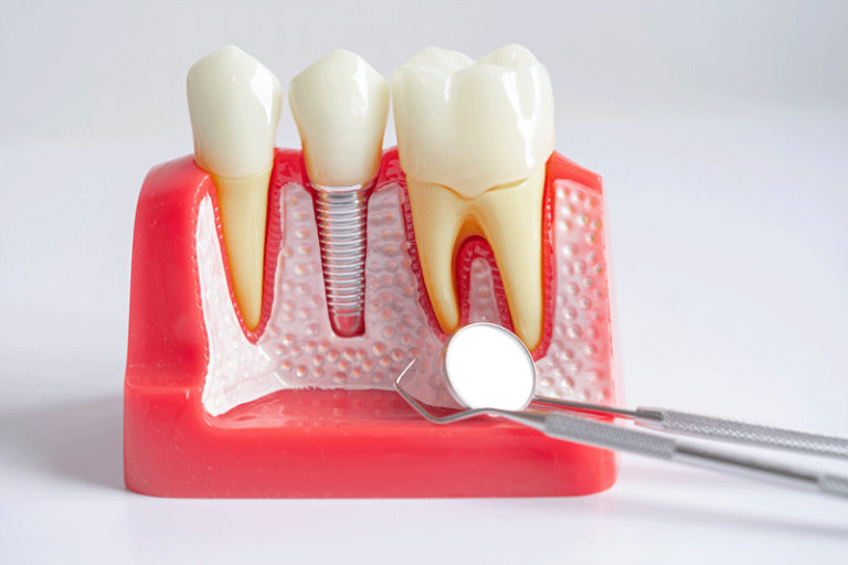 Uncover the benefits of dental teeth replacement and how dental implants can change your life. Schedule your consultation today for lasting confidence and comfort!