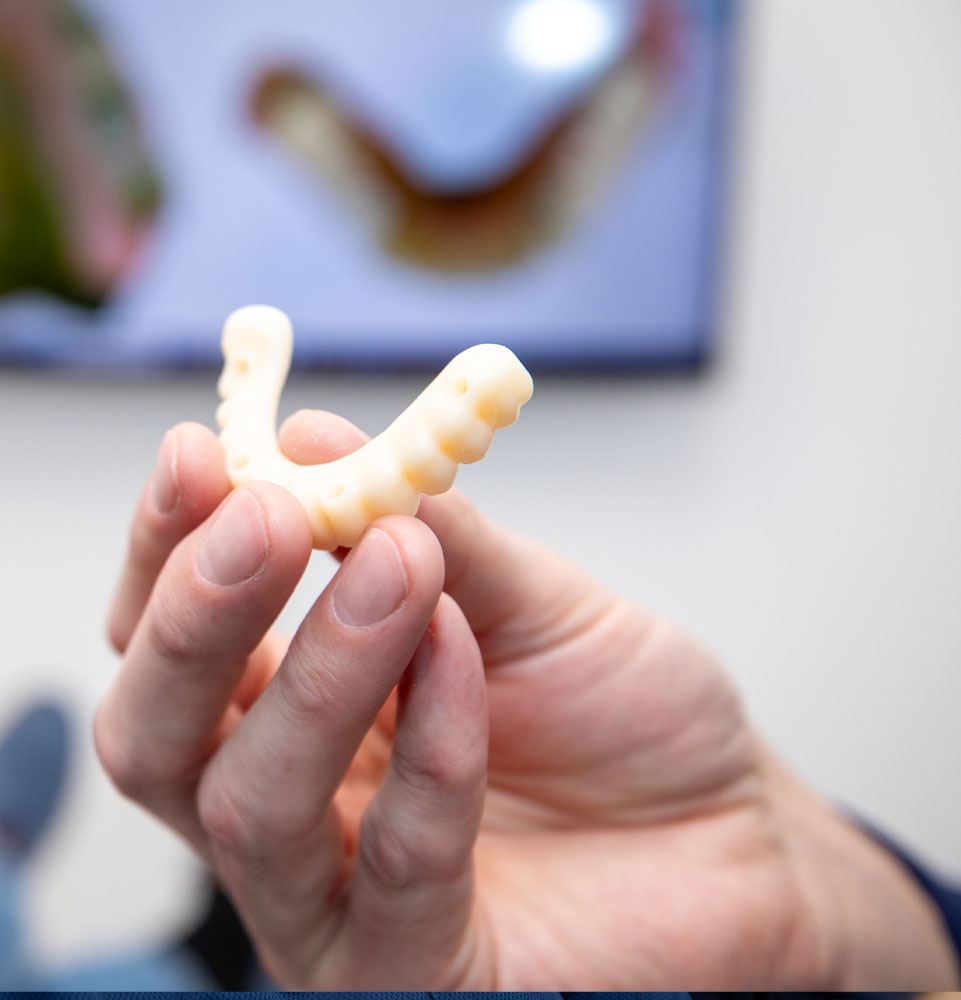 full arch implants
