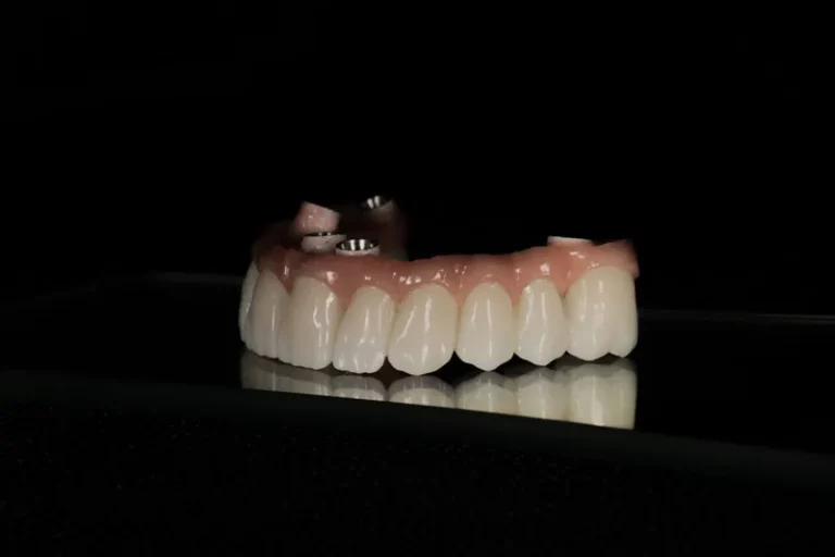 Dental Implant Model Showcasing Prosthetic Teeth on a Transparent Jaw for Educational